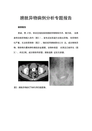 膀胱异物病例分析专题报告.docx