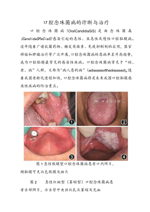 口腔念珠菌病的诊断与治疗.docx