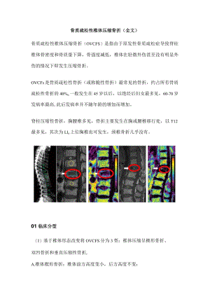 骨质疏松性椎体压缩骨折（全文）.docx