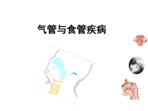 气管与食管疾病名师编辑PPT课件.ppt