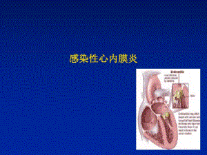 感染心内膜炎名师编辑PPT课件.ppt