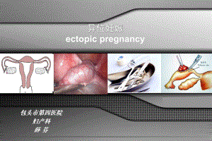 妇产科异位妊娠 .ppt