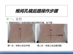 椎间孔镜后路操作步骤【ppt】 .ppt