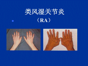 类风湿性关节炎.ppt