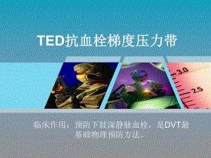 预防下肢深静脉血栓.ppt
