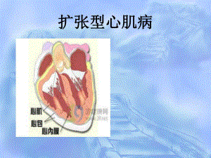 扩张型心肌病查房.ppt