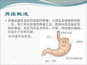胃癌的护理查房.ppt