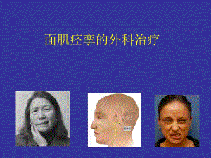 面肌痉挛.ppt