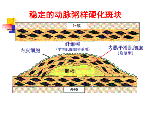 动脉硬化心脏病.ppt