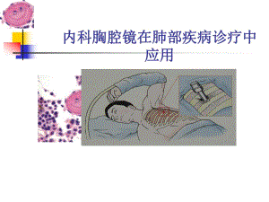 内科胸腔镜在肺部疾病诊疗中应用.ppt