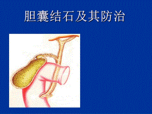 胆囊结石及防治.ppt