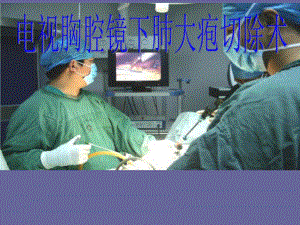 电视胸腔镜下肺大疱2.ppt