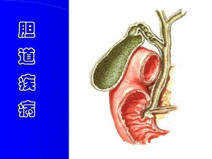 胆囊结石.ppt