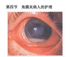 角膜炎病人的护理.ppt