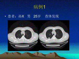 医学ppt肺错构瘤影像表现.ppt