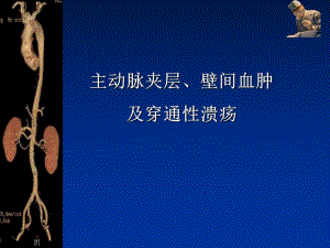 主动脉夹层、壁间血肿及穿通性溃疡.ppt