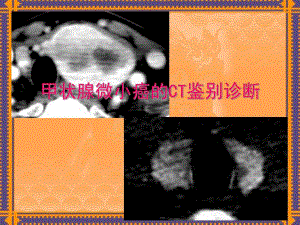 甲状腺病变的CT诊断.ppt