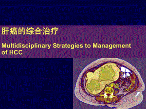 肝癌综合治疗.ppt
