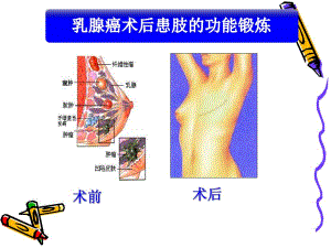 乳腺癌术后的功能锻炼.ppt.ppt