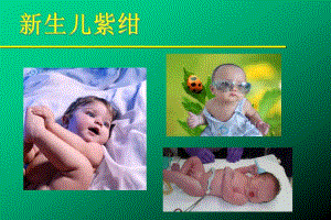 新生儿青紫.ppt.ppt