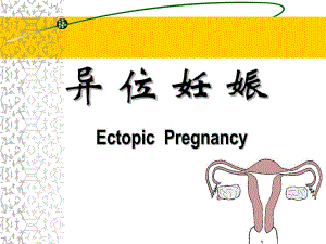 异位妊娠.ppt