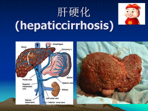 肝硬化完整.ppt