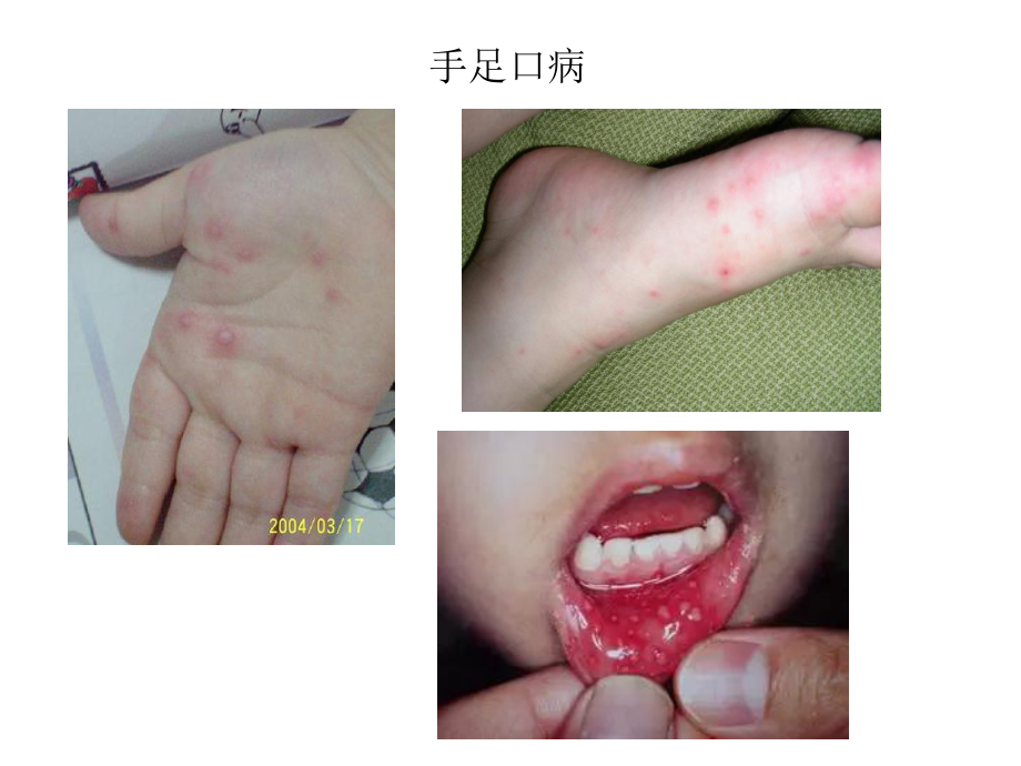 传染病症状图片.ppt_第3页