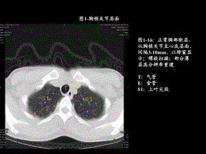 胸部CT的影像学表现.ppt