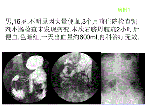 麦克尔憩室的影像学诊断.ppt