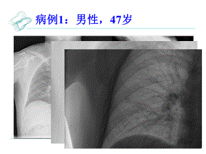 肺硬化性血管瘤影像学诊断.ppt