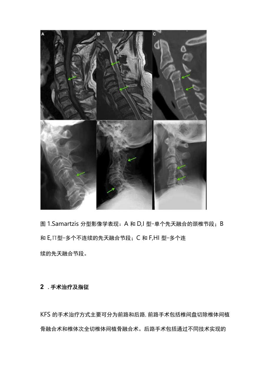 最新:Klippel-Feil综合征影像学分型指导对手术治疗的研究进展(全文).docx_第2页