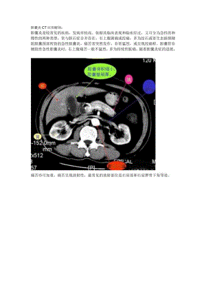 胆囊炎CT应用解剖.docx