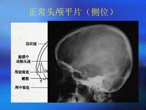 颅骨x线诊断.ppt