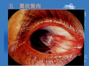 翼状胬肉及干眼症眼外伤等.ppt