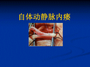 自体动静脉内瘘.ppt