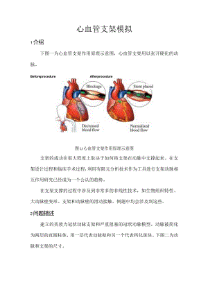 CAE-心血管支架模拟.docx