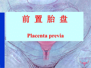 前置胎盘.ppt