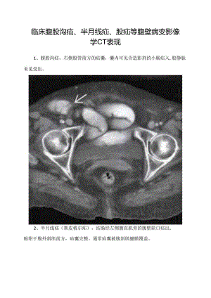 临床腹股沟疝、半月线疝、股疝等腹壁病变影像学CT表现.docx