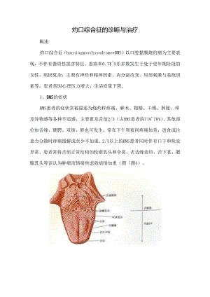灼口综合征的诊断与治疗.docx