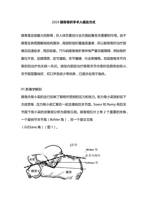 2024跟骨骨折手术入路及方式.docx