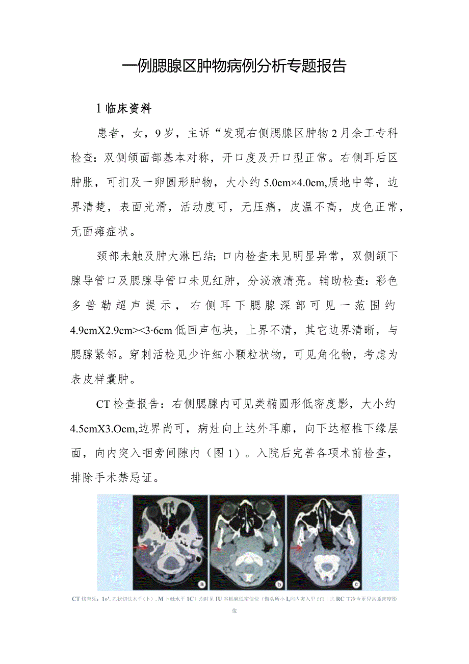 颌面外科医师晋升副主任医师病例分析专题报告(腮腺区肿物病).docx_第2页