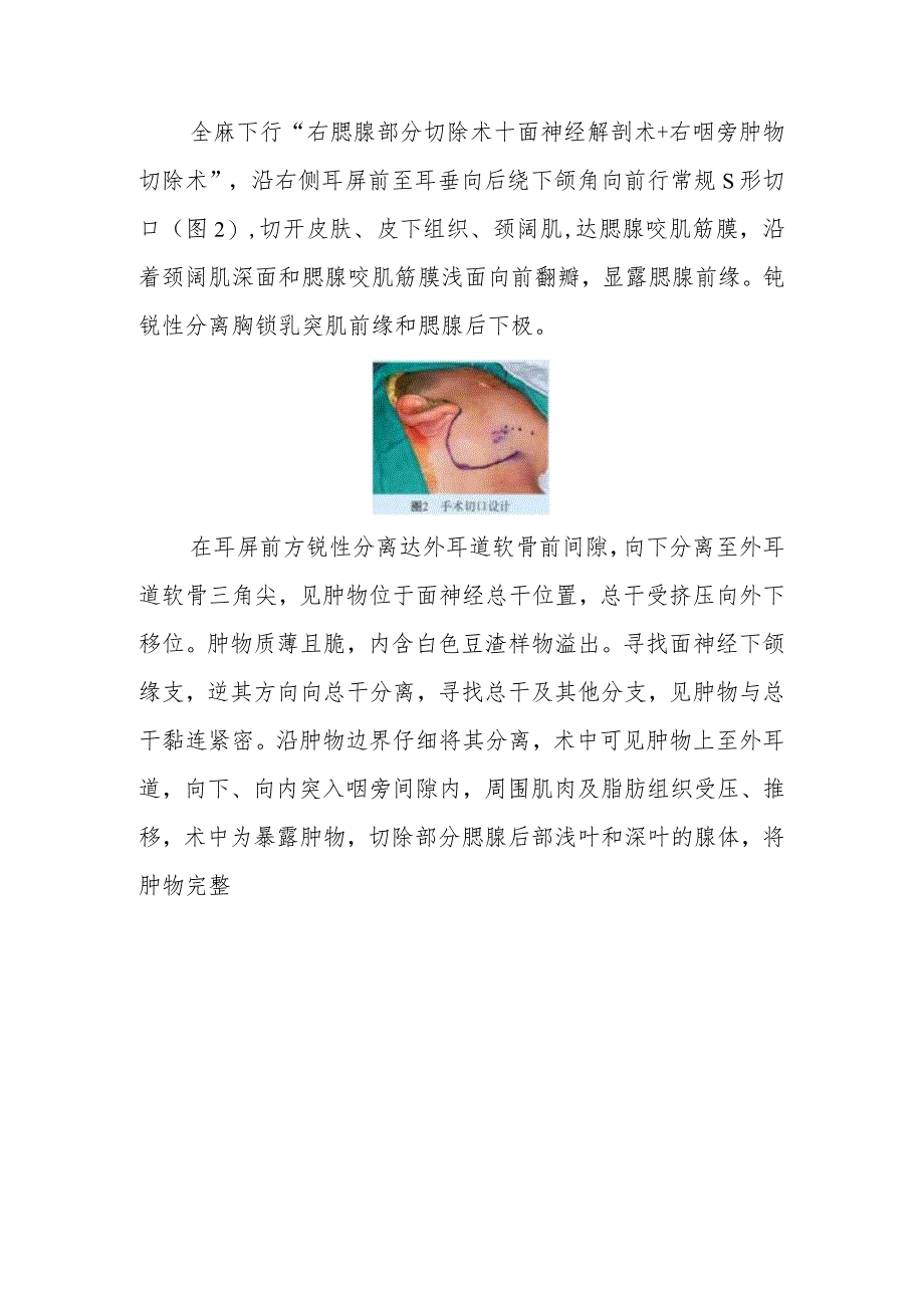 颌面外科医师晋升副主任医师病例分析专题报告(腮腺区肿物病).docx_第3页