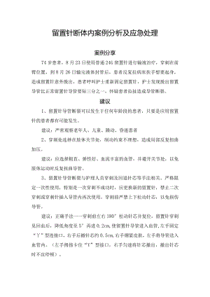 留置针断体内案例分析及应急处理.docx