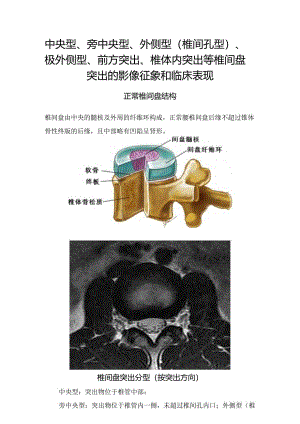 中央型、旁中央型、外侧型（椎间孔型）、极外侧型、前方突出、椎体内突出等椎间盘突出的影像征象和临床表现.docx