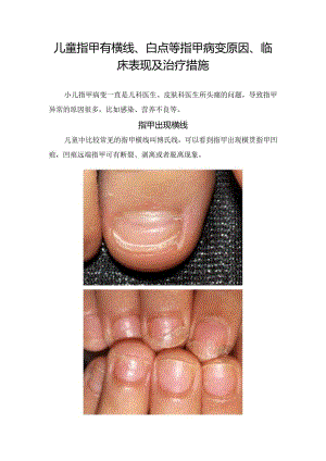 儿童指甲有横线、白点等指甲病变原因、临床表现及治疗措施.docx