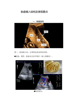 胎盘植入结构及表现要点.docx