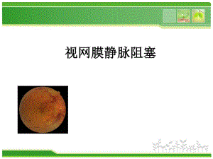 视网膜静脉阻塞.ppt