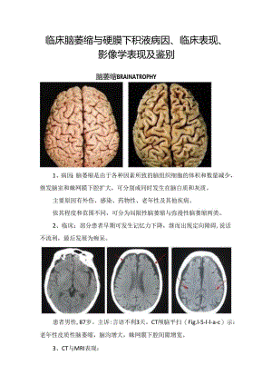 临床脑萎缩与硬膜下积液病因、临床表现、影像学表现及鉴别.docx