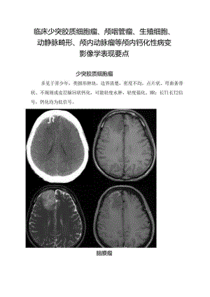 临床少突胶质细胞瘤、颅咽管瘤、生殖细胞、动静脉畸形、颅内动脉瘤等颅内钙化性病变影像学表现要点.docx