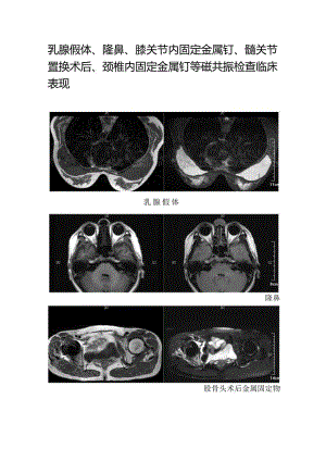乳腺假体、隆鼻、膝关节内固定金属钉、髋关节置换术后、颈椎内固定金属钉等磁共振检查临床表现.docx